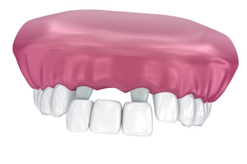 Tooth supported fixed bridge. Medically accurate 3D illustration