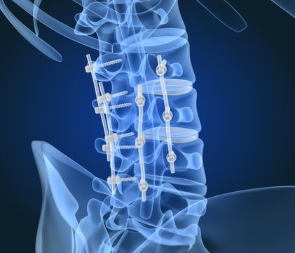 Spinal fixation system - titanium bracket. X-Ray 3D illustration