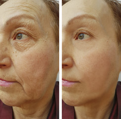 face woman wrinkles before and after