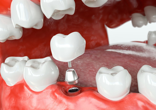 Tooth human implant -before - 3D Rendering