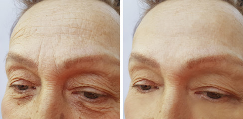 face woman elderly wrinkles before and after