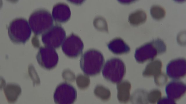 human blood smear under microscope , for analysis in laboratory 