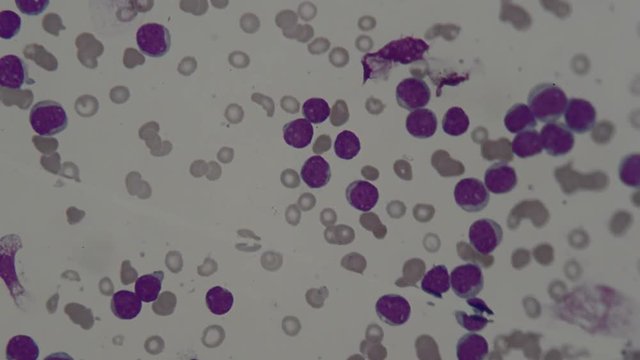 human blood smear under microscope , for analysis in laboratory 