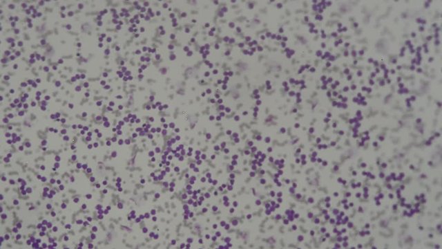 human blood smear under microscope , for analysis in laboratory 