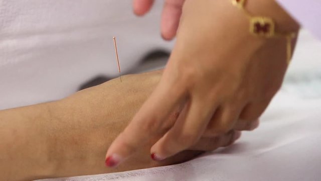 acupuncture medical procedure to arm