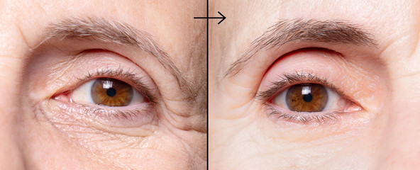 Wrinkled woman eyes before and after antiaging treatment