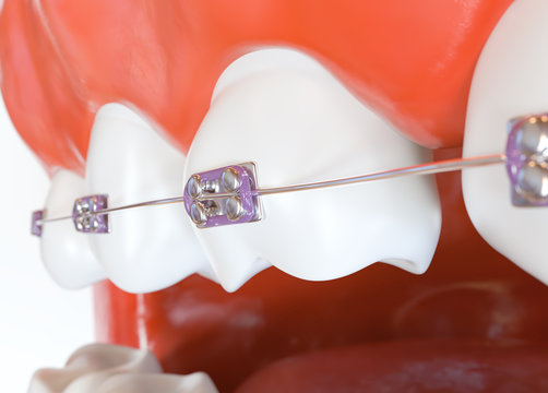 Teeth with braces or brackets in open human mouth - 3d rendering