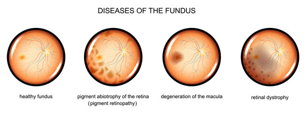 degenerative diseases of the fundus