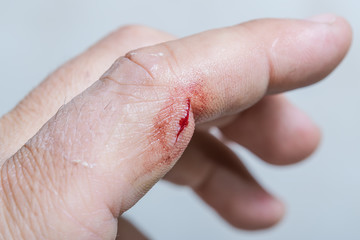 Fototapeta premium Bleeding wound - a cut on arm. An injure on the finger of a working man, closeup.