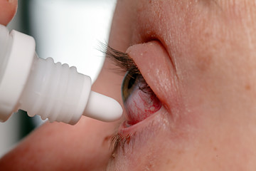 Augentropfen gegen Bindehautentzündung