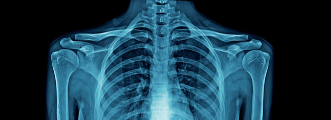 upper part of human body x-ray, high quality chest x-ray and part of spine and full AP of shoulder joint in blue tone for webpage, banner - obrazy, fototapety, plakaty