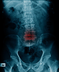 x-ray imaage show body of lumbar spine fracture, compression fracture of lumbar spine  L4-5 level