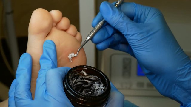 Wart removal in Cosmetic salon. The use of liquid nitrogen in dermatology.