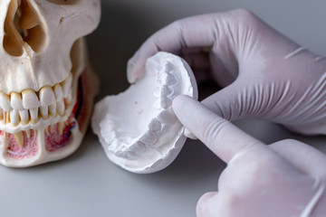 Study cast of Diagnostic cast and dental gypsum models in dental laboratory.