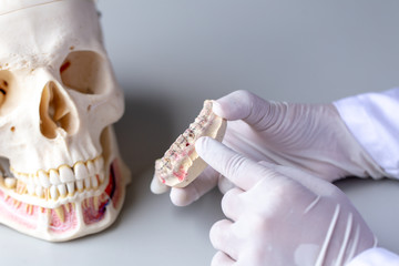 Study cast of Diagnostic cast and dental gypsum models in dental laboratory.