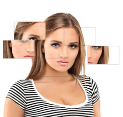 Post-Acne Marks /Treating Acne Scars.Acne Scar Removal