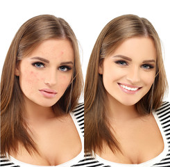 Post-Acne Marks /Treating Acne Scars.Acne Scar Removal.