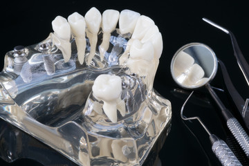 implant and orthodontic model for student to learning teaching model showing teeth.