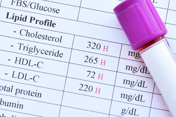 Abnormal high lipid test result with blood sample