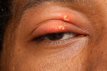 Herpes simplex in eyelid of african man