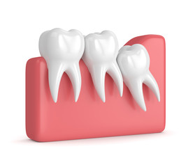 3d render of teeth with wisdom crowding