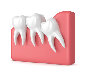 3d render of teeth with wisdom crowding