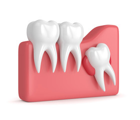 3d render of teeth with wisdom cyst