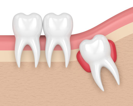 3d render of teeth with wisdom cyst