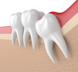 3d render of  wisdom mesial impaction with pericoronitis
