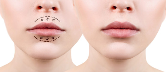 Lips of young woman before and after augmentation
