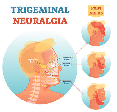 Trigeminal neuralgia medical cross section anatomy vector illustration diagram with facial neural network and pain areas.