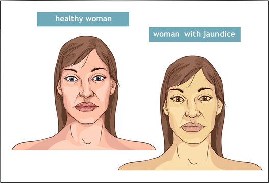 vector illustration of a Jaundice Disease