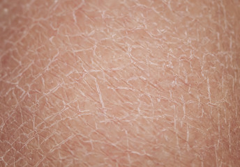 texture of human skin large with dermatological problems of dryness and cracking - obrazy, fototapety, plakaty