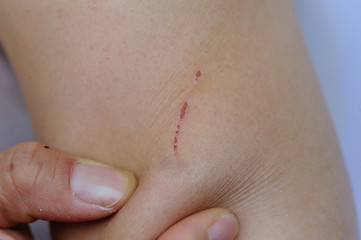 people with wounded arm holding in hand