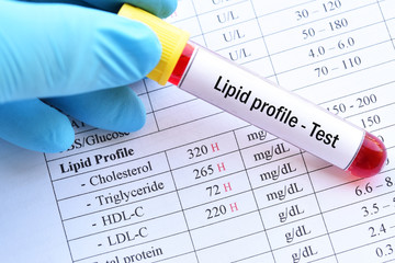 Abnormal high lipid test result with blood sample