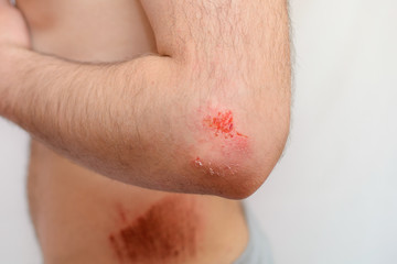 close-up bleeding wound or bruised hand on the elbow of a man on a white isolated background