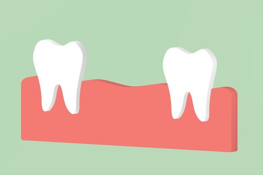 missing tooth, space between teeth in mouth