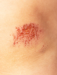 Fototapeta premium abrasion on the child's knee
