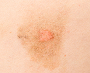 Fototapeta premium Ringworm on the body