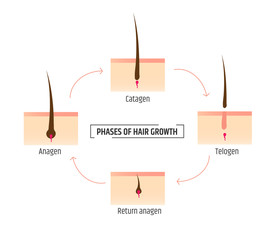 hair growth phases. Infographics trichology and dermatology. Laser Hair Removal