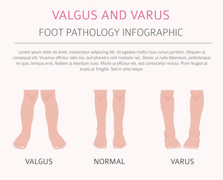 Foot deformation as medical desease infographic. Valgus and varus defect