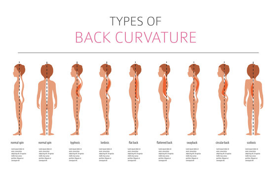 Types of back curvature. Medical desease infographic