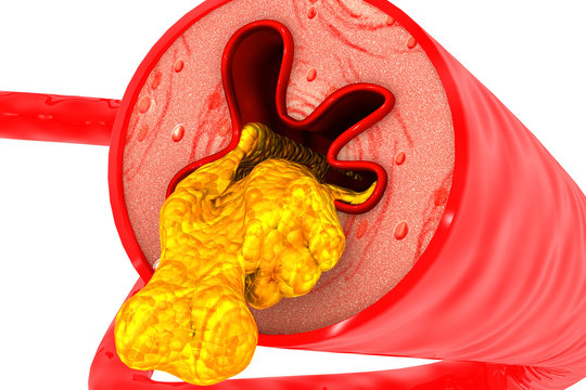 Artery Blocked With Cholesterol