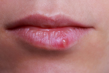 herpes on the lips