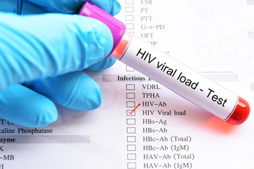 Blood sample for HIV viral load test