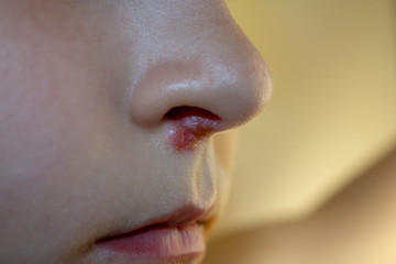 Herpes on the nose - Pretty young caucasian boy with herpes her on nose. Close-up. Human Virus