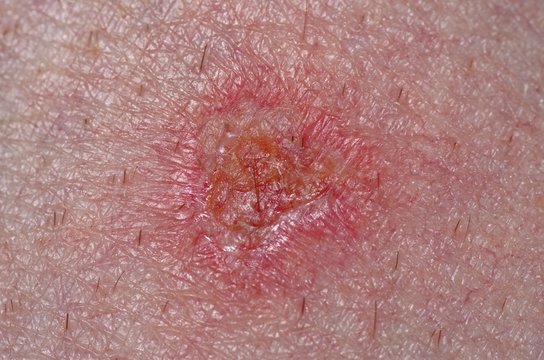 Second-degree burn of the leg. Selective focus.