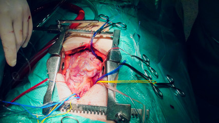 Doctor doing heart operation heart transplant operation