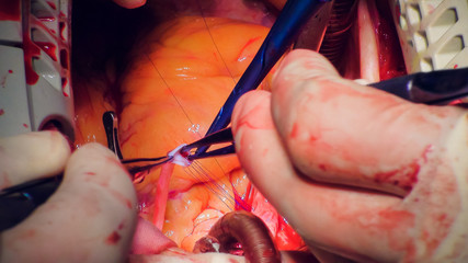 Doctor doing heart operation heart transplant operation