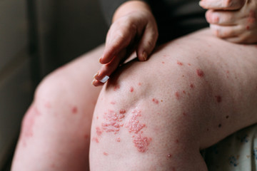 Fototapeta premium applying an emollient to dry flaky skin as in the treatment of psoriasis, eczema and other dry skin conditions. Skin problem concept